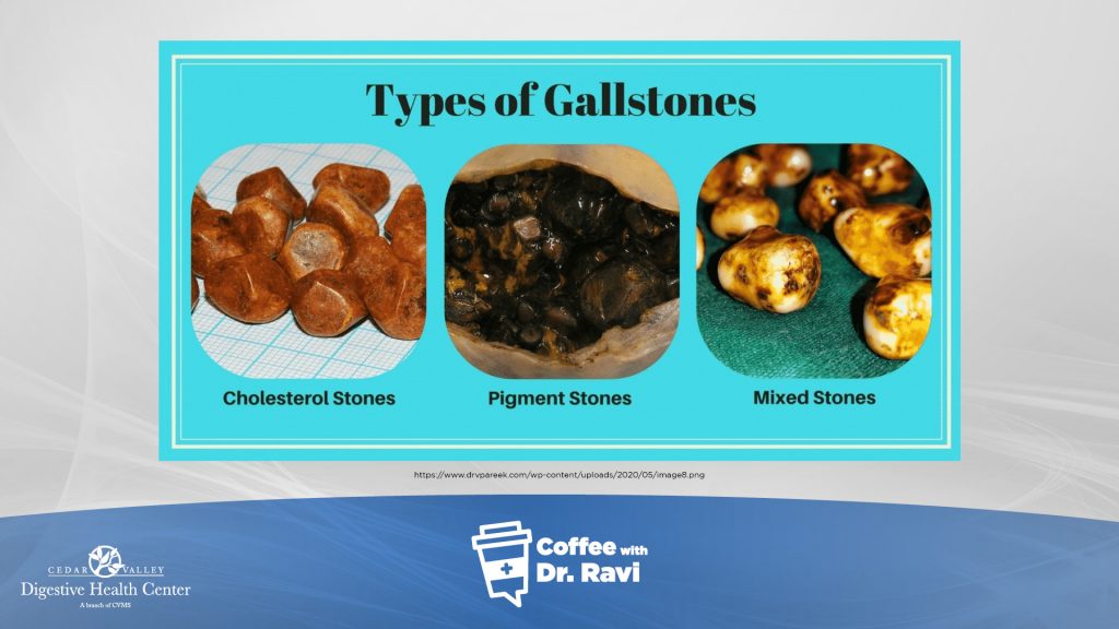 Coffee with Dr. Ravi 74 Gallstone Disease Cedar Valley Digestive